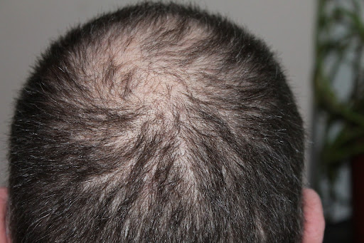 stages of male pattern baldness