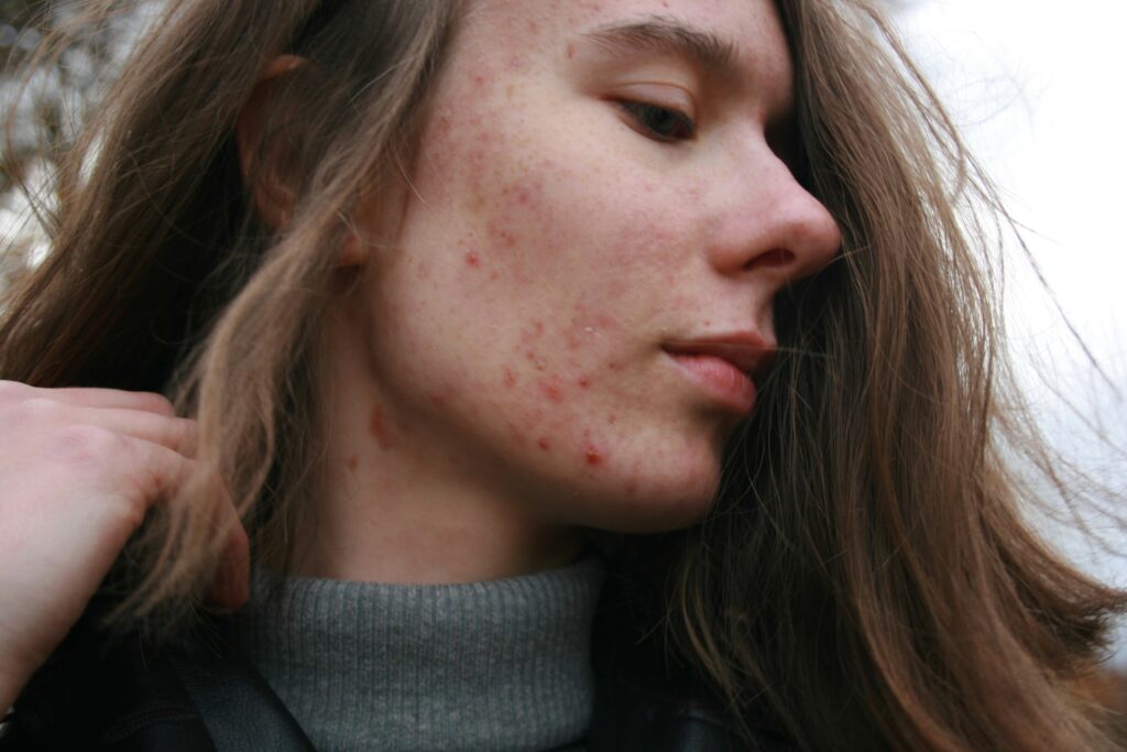 acne, lower testosterone in woman