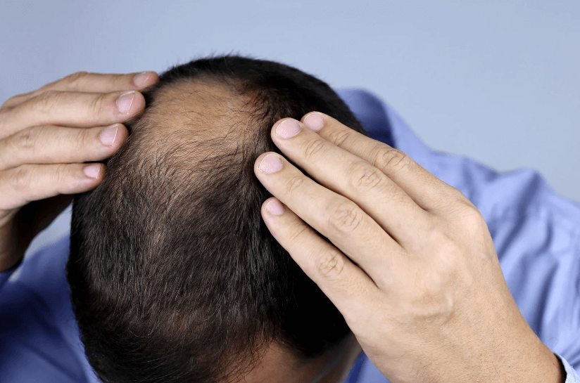 does-low-testosterone-cause-hair-loss